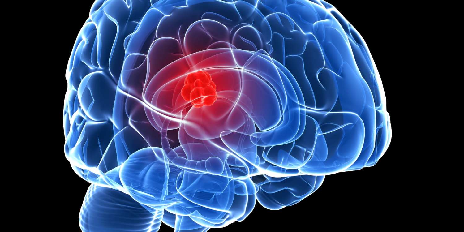 #WorldBrainTumourDay: Know about types and prevention