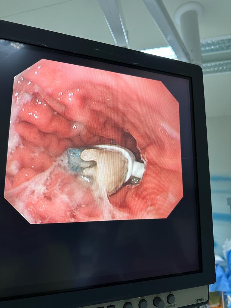 Saudi child swallowed toothbrush 20 min surgery to extract brush from 9-year-old intestines1