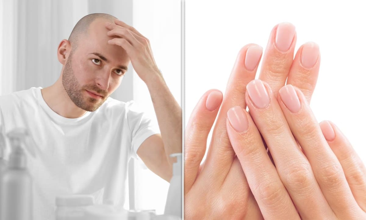 Men can look at their fingers to check how likely they are to end up bald scientists say