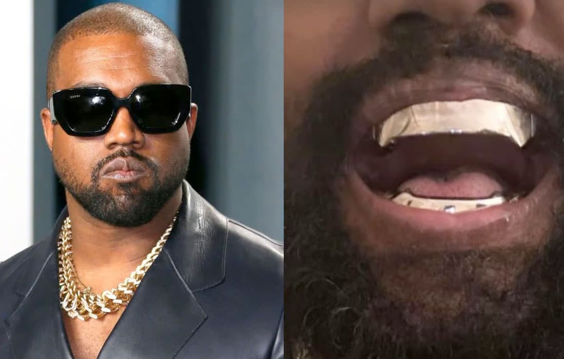 Kanye-West-teeth-titanium