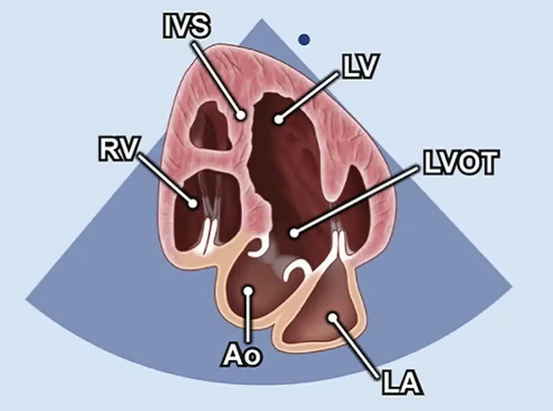 5-chamber-Heart-Surgery-Aster Hospital - Medical Break-through