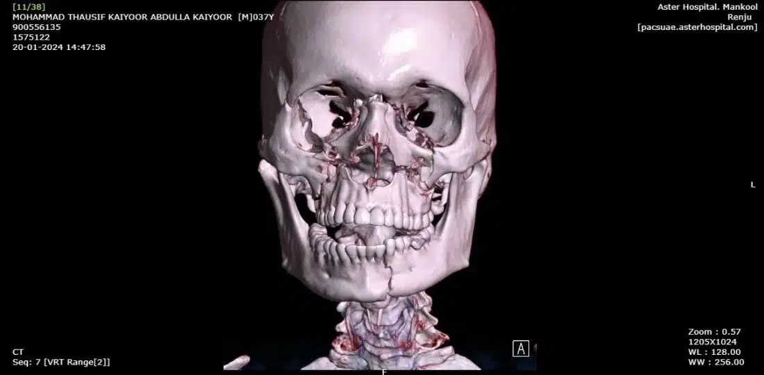 Aster Hospital Mankhool Rebuilds Young Man’s Face After Severe Road Accident causes Complex Facial Fractures
