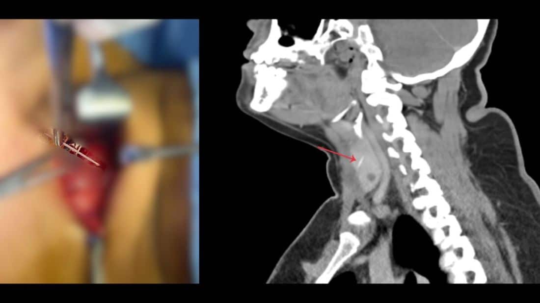 Doctor removes 3cm fish bone from woman’s thyroid at Aster Hospital