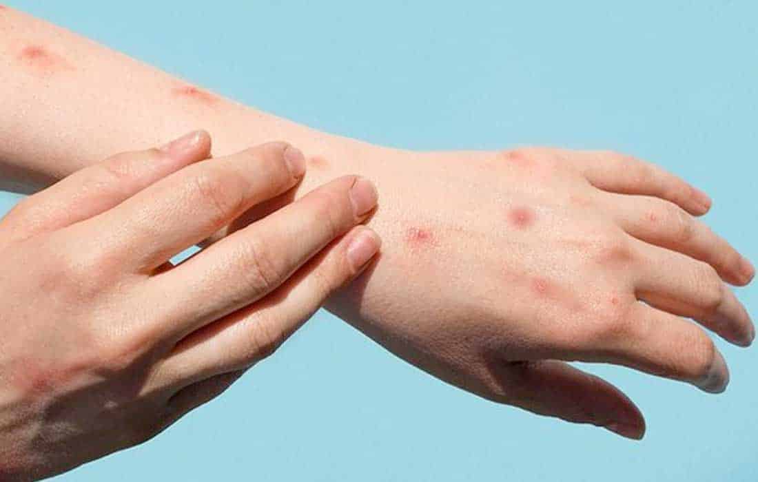 First case of Mpox detected in Sweden