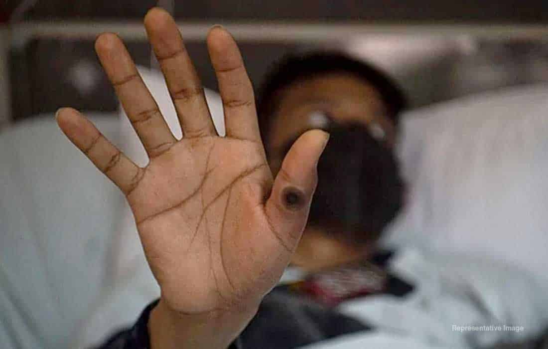 Mpox virus detected in Pakistan Khyber Pakhtunkhwa