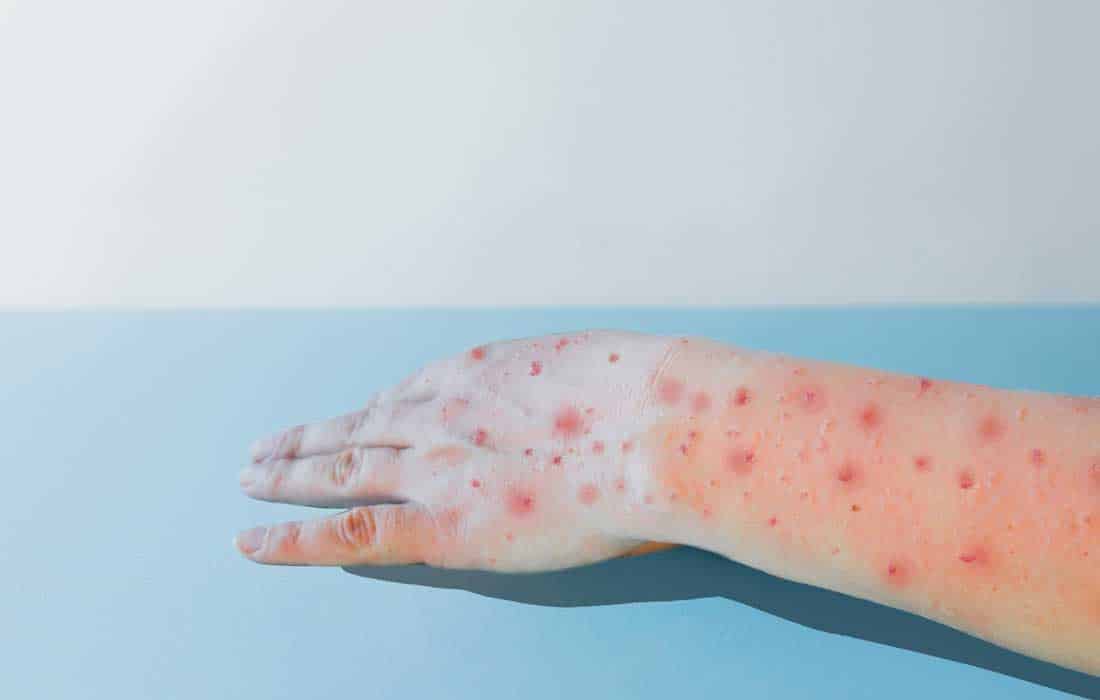 Thailand reports suspected case of new mpox strain