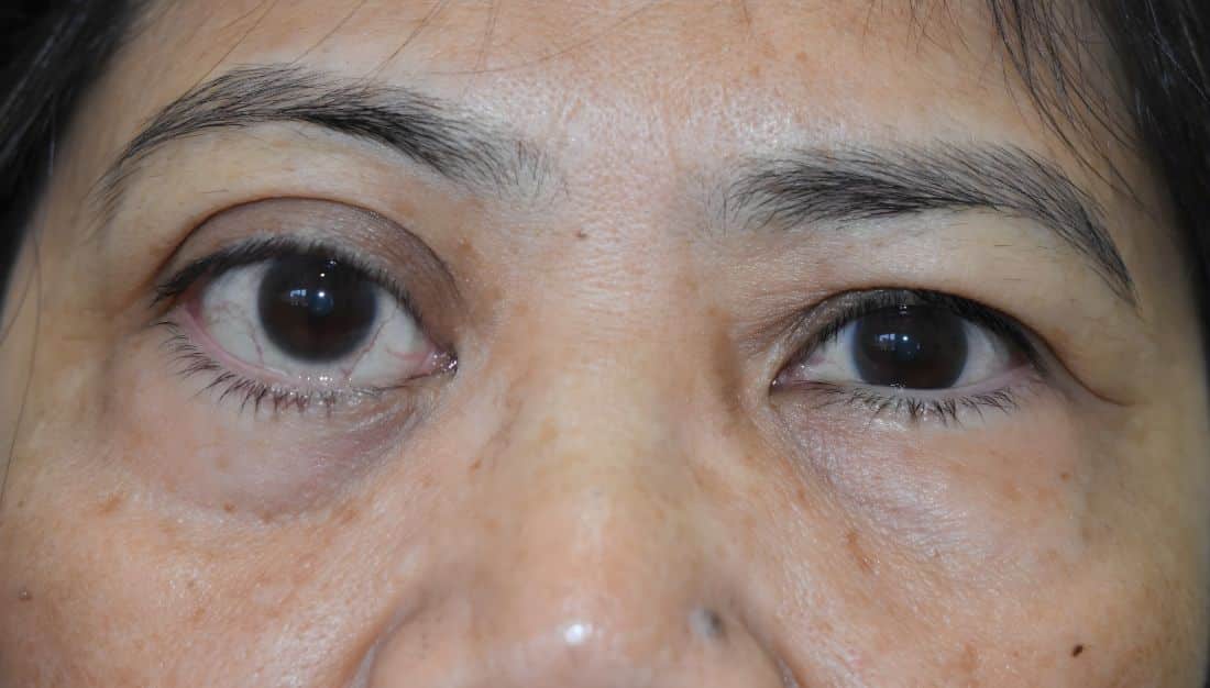 Eye tumor larger than an eyeball in size, surgically removed to help Filipina expat regain vision at Medcare Hospital Sharjah