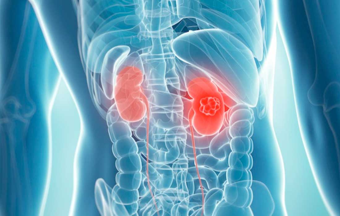 Rare kidney cancer breakthrough in lab